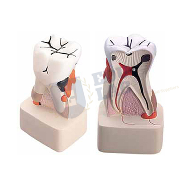 Dental Pathology Model